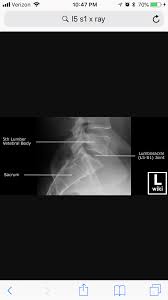 Lumbar L5 S1 Cone Down Xray X Ray Xray Tech Radiology Technologist