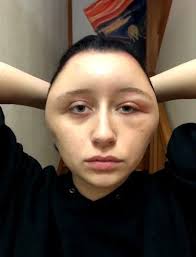 Student S Head Doubled In Size After Suffering Allergic Reaction To Hair Dye Dyed Hair Hair Blog Cheap Hair Color