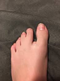 Did you scroll all this way to get facts about webbed toes? My Webbed Toes Mildlyinteresting