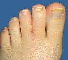 See detailed information below for a list of 117 causes of webbed toes, symptom checker, including listed below are some combinations of symptoms associated with webbed toes, as listed in our database. Webbed Toes Wikipedia