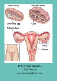 Learn more about pcos, including how it affects a. Polycystic Ovarian Syndrome Pcos Creating A Family