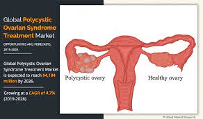 Tiny holes made in the ovaries can reduce the levels of androgens being produced. Polycystic Ovarian Syndrome Treatment Market Size Growth 2026