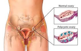 Women with polycystic ovary syndrome have intrinsic insulin resistance on role of metformin for ovulation induction in infertile patients with polycystic ovary syndrome (pcos): Pcos Polycystic Ovary Syndrome Overlake Reproductive Health