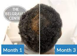 Unfortunately, not all hair shedding is due to the hair cycle. Can You Treat A Thinning Crown In Men With Afro Hair