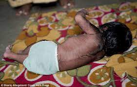 Melanin is responsible for the pigment in our skin, hair and eyes, and it protects the skin from the sun's harmful rays. Baby Girl Born Covered Head To Toe In Hair After Inheriting Rare Werewolf Syndrome Gene Daily Mail Online