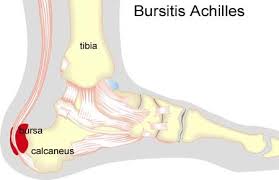 Inflammation Of The Bursa At The Attachment Of The Achilles To The Heel Bone Sportnetdoc Bursitis Treatment Heel Bursitis Achilles