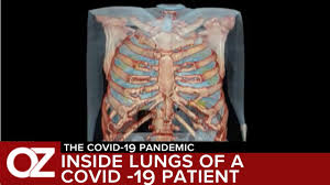 Inside The Lungs Of A Covid 19 Patient Days After He Had No Symptoms Youtube