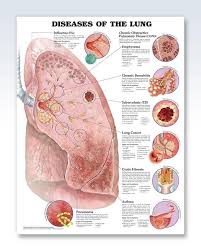 Diseases Of The Lung Anatomy Poster Clinicalposters Medical Knowledge Lung Anatomy Medical Education
