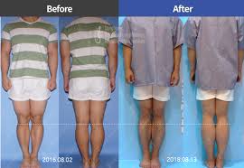 Wanna Grow Taller Cosmetic Leg Lengthening Surgery In South Korea How To Grow Taller In Cosmetics Lengthen
