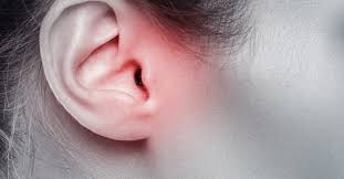 Migraine In The Ear Nose And Throat Clinic Facebook Live Recap