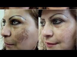 Haz Que Tu Cara Sea La Envidia De Toda La Familia No Tiene Ni Una Arruga Y Un Cutis Precioso G Mascarillas Naturales Mascarillas Para Acne Quitar Manchas Cara