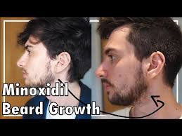 Is rogaine/minoxidil effective for beard growth? Minoxidil Beard Growth Three Months Youtube