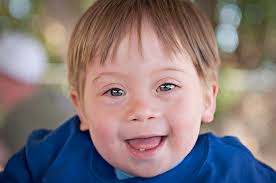Medical conditions that cause the nasal bridge not to develop and project are also associated with epicanthic fold. Sometimes You Can Tell A Book By Its Cover Shared Developments Of The Brain And Face Science Over A Cuppa