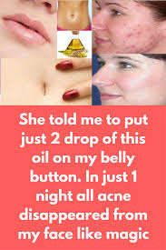 She Told Me To Put Just 2 Drop Of This Oil On My Belly Button In Just 1 Night All Acne Disappeared From My Face Like Magic You Mig Painful Pimple Acne Pimples