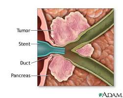 Pin On Pbc Other Liver Disease