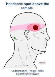 Headache All Over Or In A Band Around The Head Integrative Works Home Remedy For Headache Headache Remedies Trigger Points