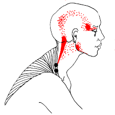Pin On Trigger Points