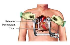 Open Heart Surgery Diagram After Chest Incision And Sternotomy Open Heart Surgery Heart Surgery Heart Surgery Recovery