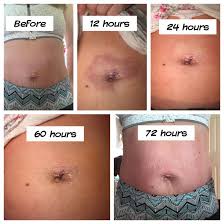 Umbilical Hernia Repair Recovery With Pictures Umbilical Hernia Umbilical Hernia Repair Hernia Repair
