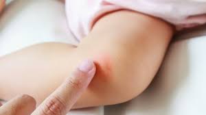 Waspada Kaki Merah Dan Gatal Pada Anak Jadi Gejala Virus Corona Covid 19