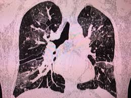 Pin On Radiology Interesting Cases And Spotters