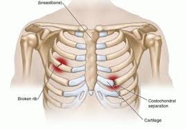 Costochondritis Costochondritis Rib Fracture Dislocated Rib