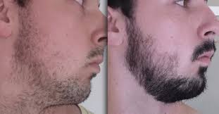 We will give some advice (and have done so in depth before here). How Long To Leave Minoxidil On Face Imanscape