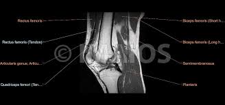 It is constructed by 4 bones and an extensive network of ligaments and muscles.1. The Knee Mri Atlas Of Anatomy In Medical Imagery