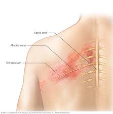 Shingles Symptoms And Causes Mayo Clinic An acute infection caused by the herpes zoster virus, the same virus as causes chickenpox. shingles symptoms and causes mayo