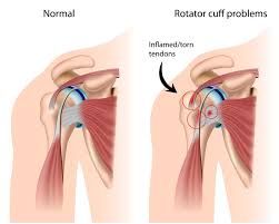 The subacromial bursa lies on the superior aspect of the supraspinatus tendon (see the images below). Rotator Cuff Injury Harvard Health