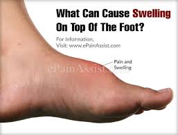 What Can Cause Swelling On Top Of The Foot Swelling Feet Stress Reaction Swellings