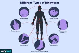 We turned to infectious disease experts to set things straight. Ringworm Overview And More