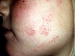 Tinea Faciei Dermnet Nz Ringworm is one of those infections you've heard of but probably wouldn't know how to spot, or what to do if you ever contracted it. tinea faciei dermnet nz