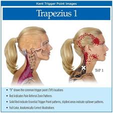 Pin On Fibro And Migraines