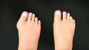 Minimally Invasive Bunion Removal Short Animation Https Www Youtube Com Watch V Gnwrnpz2inq Bunions Bunionsurgery Bunion Surgery Bunion Cure Bunion