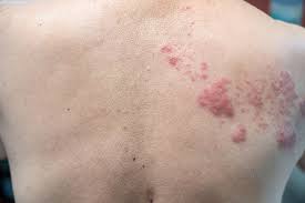 Shingles Herpes Zoster Thomson Specialist Skin Centre Find the perfect shingles medical stock photo. shingles herpes zoster thomson