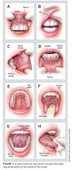 Pin De Hannah Savoie En Dental Stuff Cancer Oral Oral Consejos Para La Salud