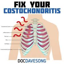 Pin On Costochondritis