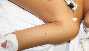 5 Year Old Boy With Abdominal Pain And Fever