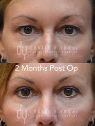 Pin On Eye Surgeries