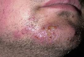 Ringworm Pictures What A Ringworm Rash Looks Like On the palms and between the fingers, though, you may mistake. ringworm pictures what a ringworm rash