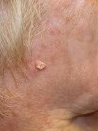 Pin On Skin Moles