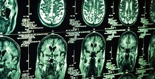 Inoperable Brain Tumors Brain Surgery Com
