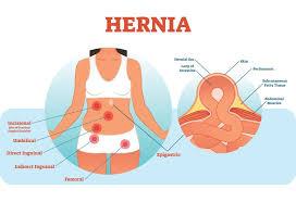 Hernia In Pregnancy Types Causes Symptoms Treatment