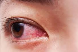 Les douleurs des yeux ou oculaires constituent un motif fréquent de consultation. Episclerite Tout Savoir Sur Cette Inflammation De L Oeil