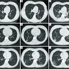 Pdf Radiological Follow Up Of Twelve Covid 19 Patients With Initially Normal Chest Ct