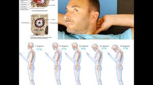 It is a normal phenomenon if it follows prolonged physical or mental activity, and resolves completely with rest. Douleur De Nuque Epaules Et Fatigue Oculaire Cts Christophe Carrio