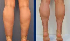 Calf Liposuction Before And After 6 Liposuction Lipo Before And After Cosmetic Surgery