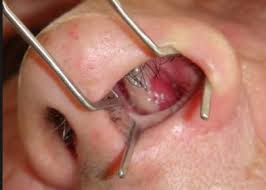 What Is Nasal Polyps Surgery And Is It Effective Polyp Surgery Polyps Symptoms