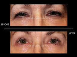 Female Blepharoplasty Eyelid Surgery Plastic Surgery Female